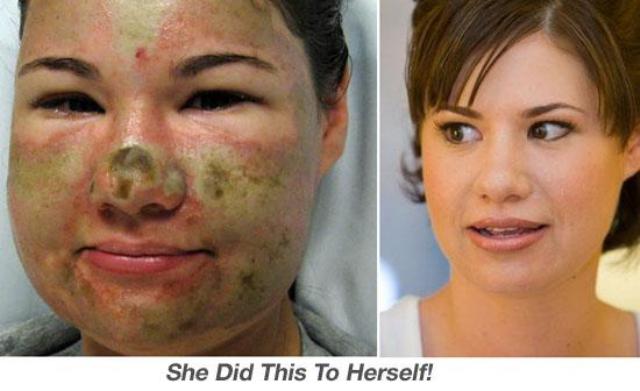 Acid_Victim